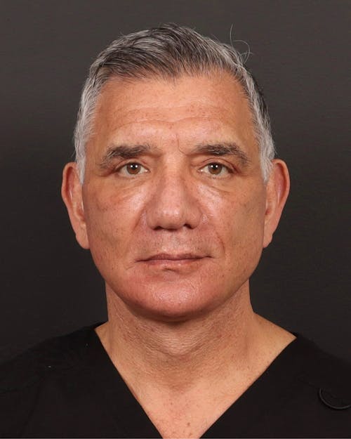 Facelift before and after - after
