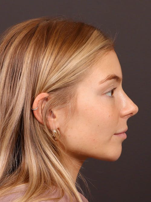 Chin before and after - after