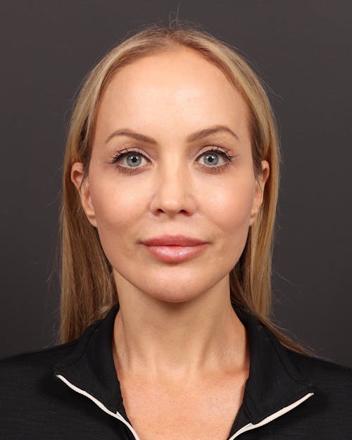 Facelift before and after - after