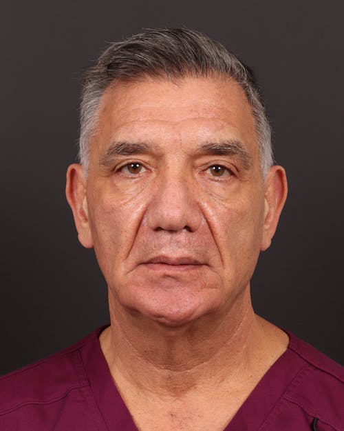Facelift before and after - before