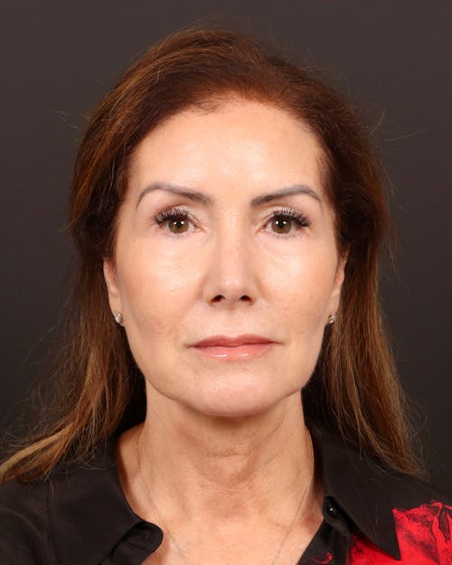 Facelift before and after - before