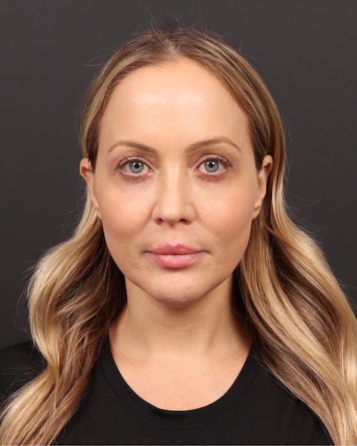 Facelift before and after - before