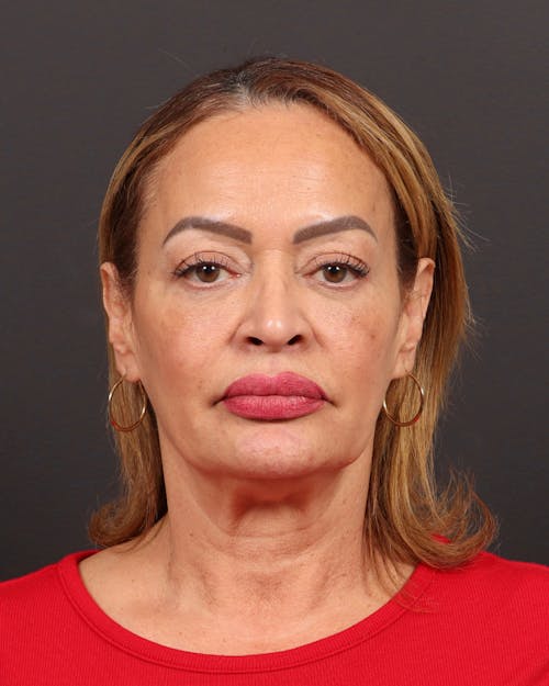 Facelift before and after - before