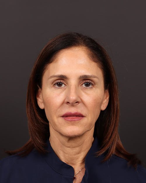 Facelift before and after - before