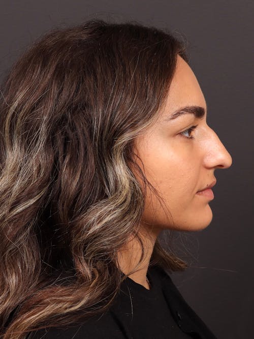 Rhinoplasty before and after - before