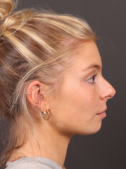Chin before and after - before