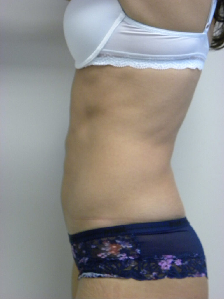 Liposuction before and after - after