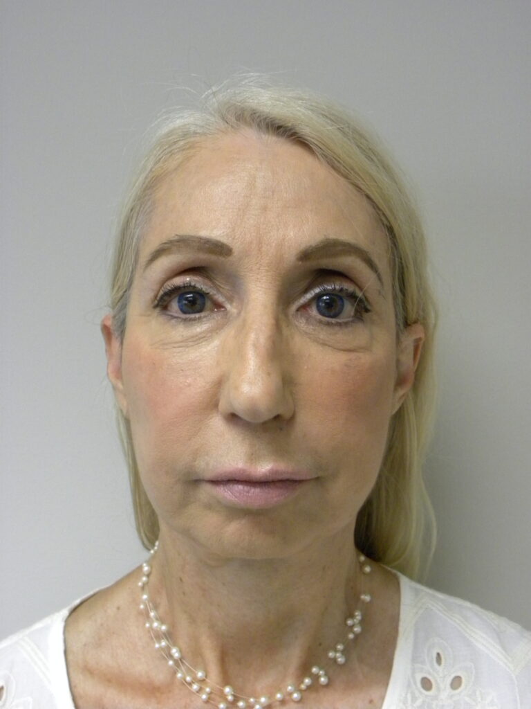 Facelift before and after - after