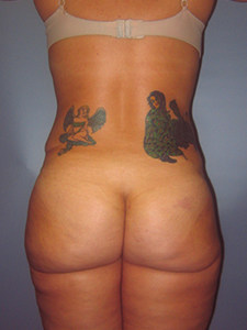 Liposuction before and after - after