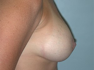 Breast Lift before and after - after