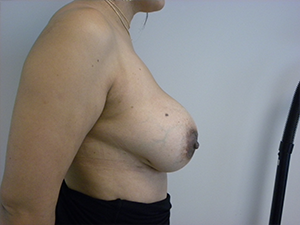 Breast Augmentation before and after - after