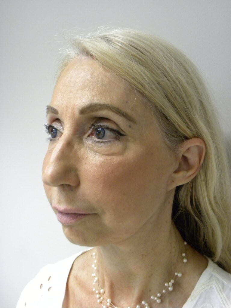 Facelift before and after - after