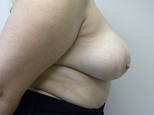 Breast Reduction before and after - after