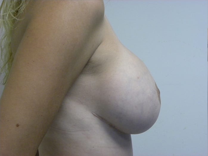 Breast Augmentation before and after - after