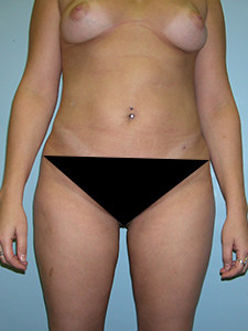 Liposuction before and after - after