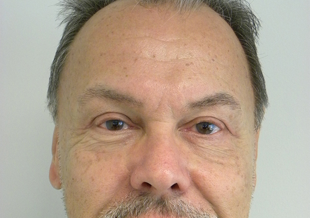 Blepharoplasty before and after - after