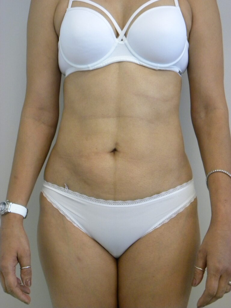 Liposuction before and after - after