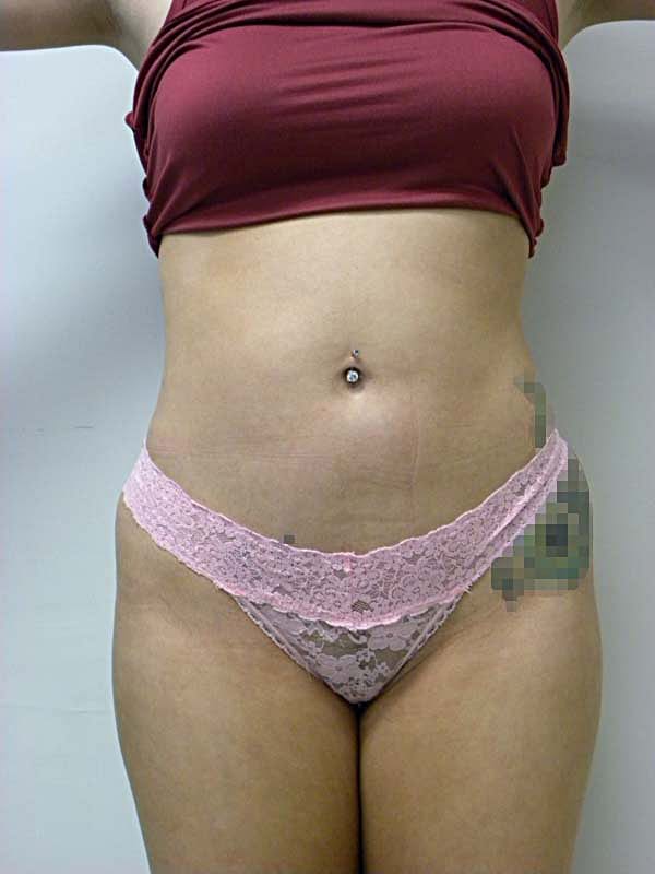 Liposuction before and after - after