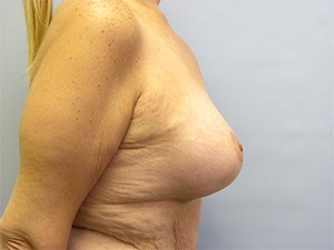 Breast Lift before and after - after