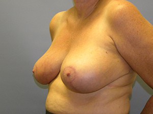 Breast Reduction before and after - after