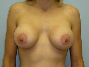 Breast Lift before and after - after