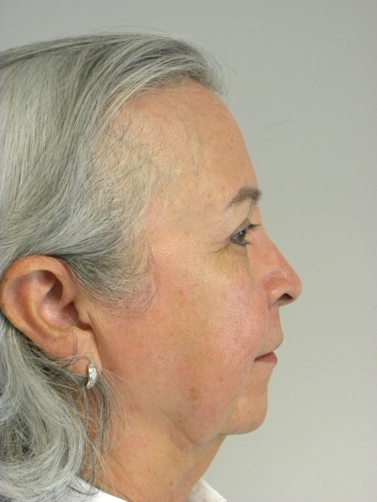 Blepharoplasty before and after - after
