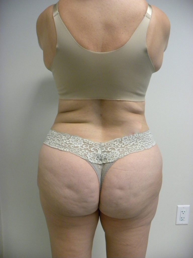 Liposuction before and after - after