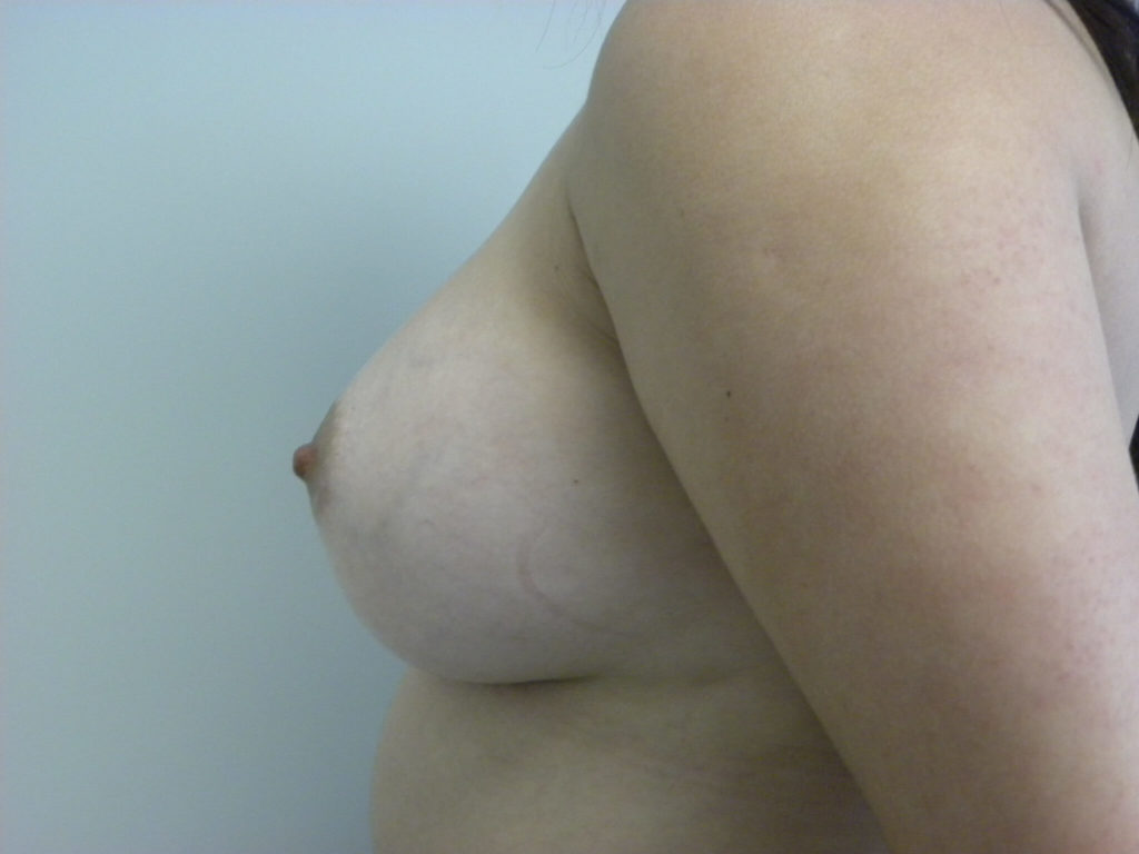 Breast Augmentation before and after - after