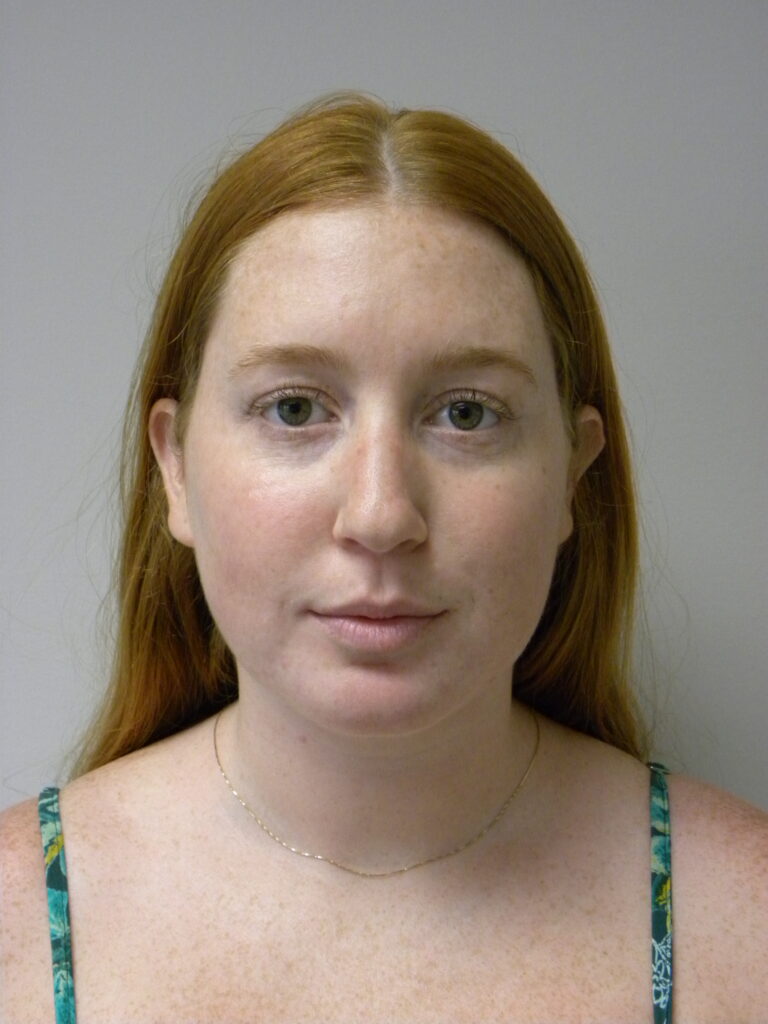 Chin before and after - after