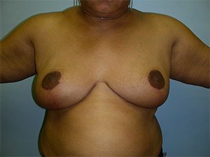 Breast Reduction before and after - after