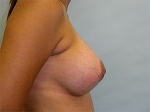 Breast Augmentation before and after - after