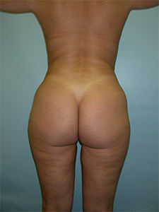 Liposuction before and after - after