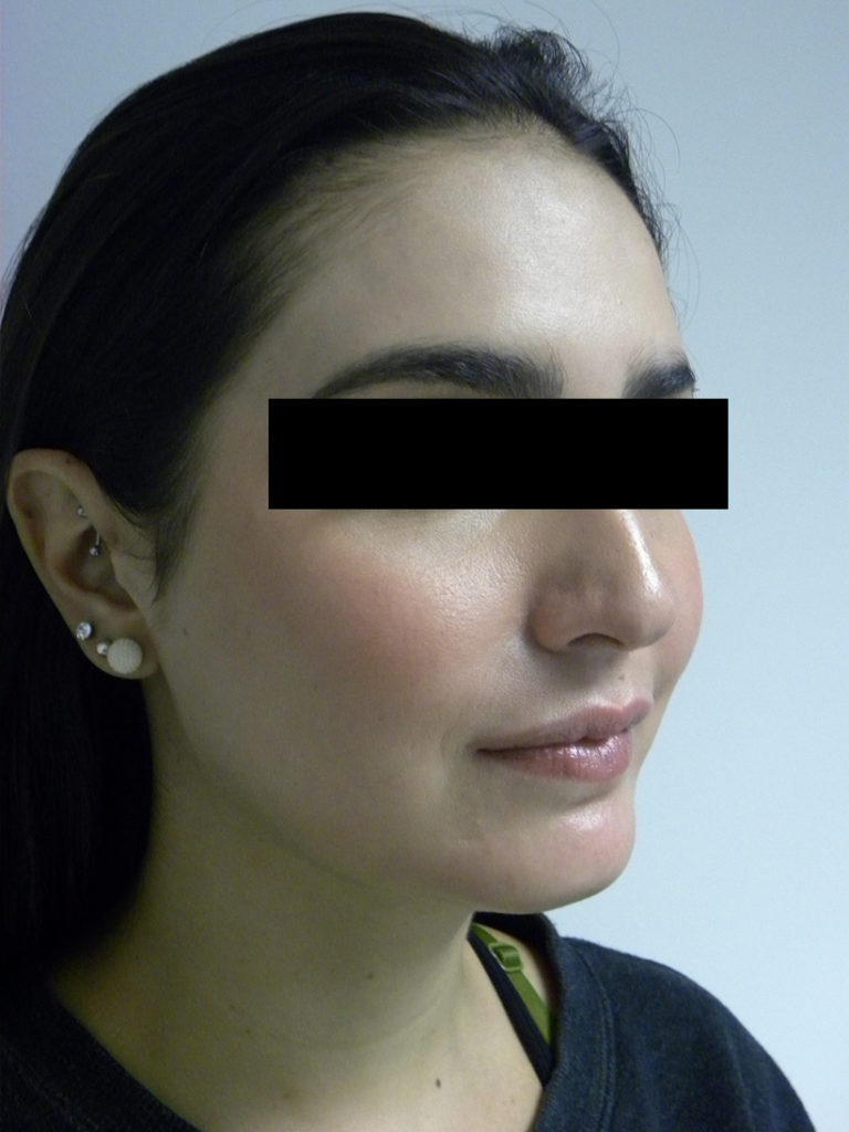 Chin before and after - after