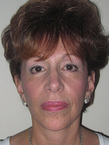 Facelift before and after - after