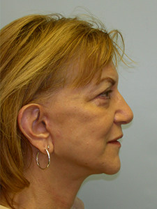 Facelift before and after - after