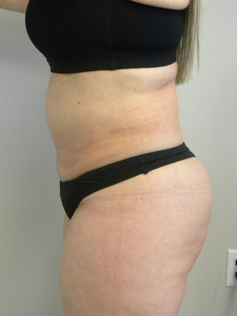 Liposuction before and after - after
