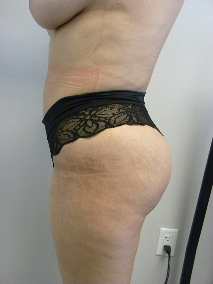 Liposuction before and after - after