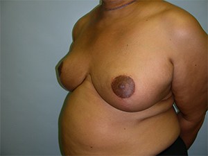 Breast Reduction before and after - after
