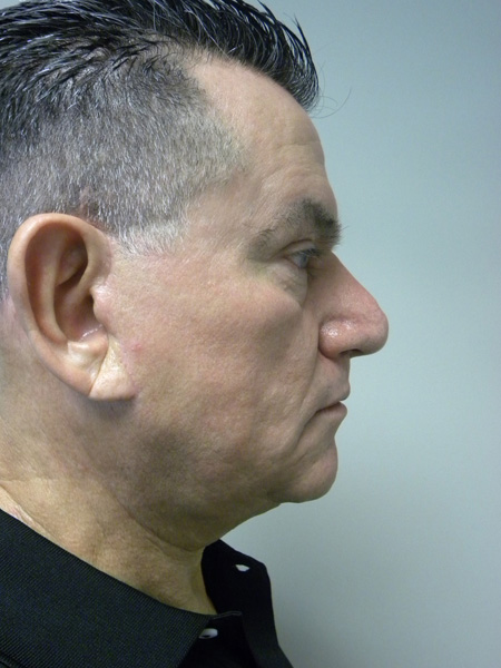 Facelift before and after - after