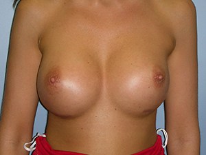 Breast Augmentation before and after - after