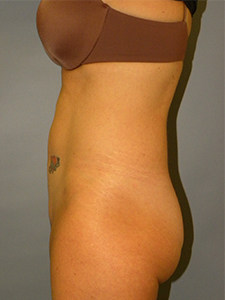 Liposuction before and after - after