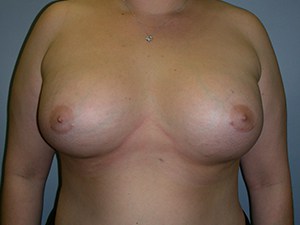Breast Augmentation before and after - after