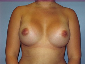 Breast Augmentation before and after - after