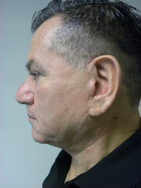 Facelift before and after - after