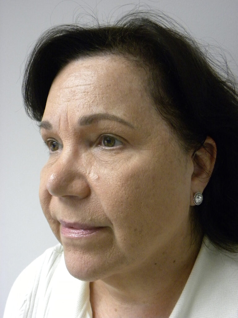 Blepharoplasty before and after - after