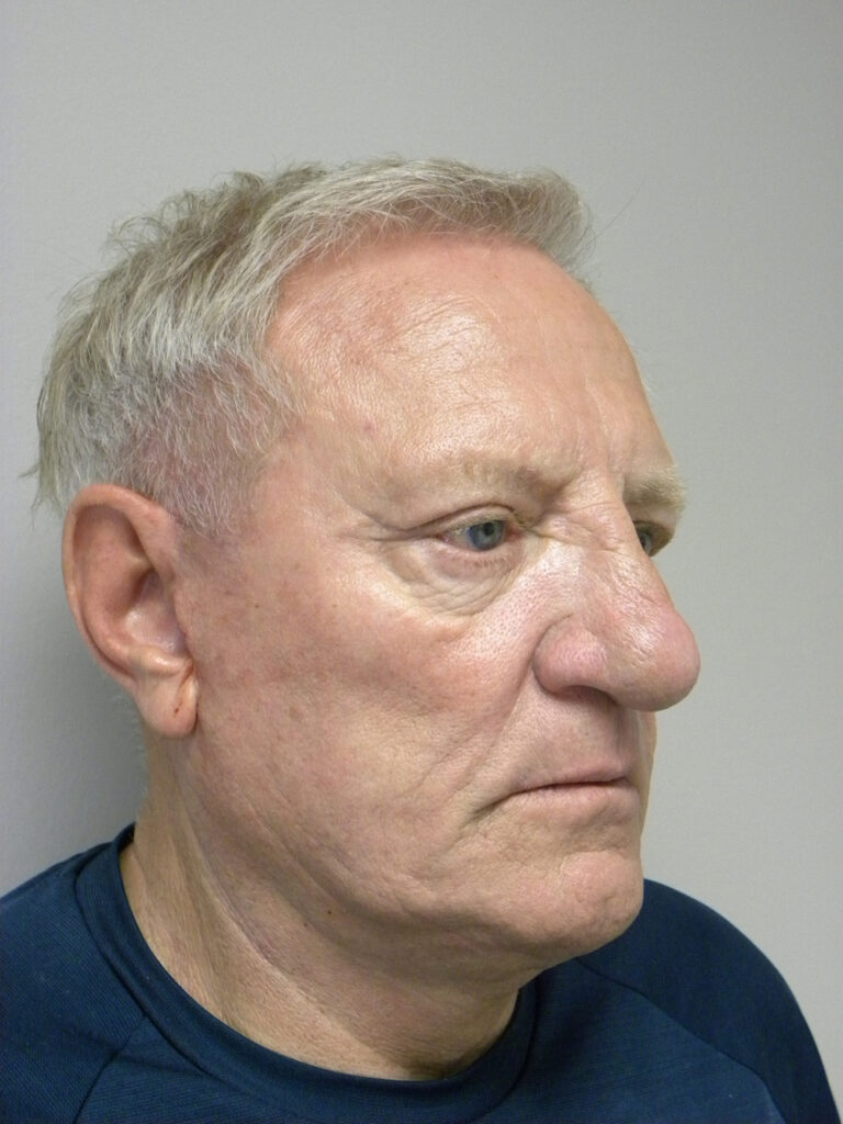 Facelift before and after - after