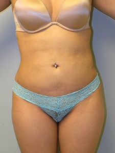 Liposuction before and after - after
