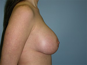Breast Augmentation before and after - after