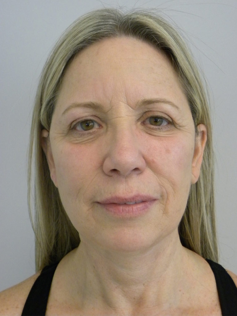 Facelift before and after - after