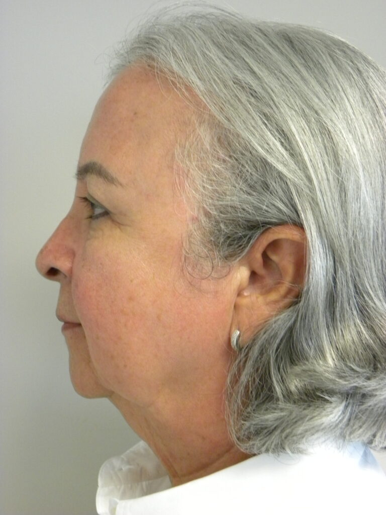 Blepharoplasty before and after - after